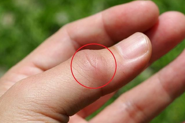 为什么说痛风和关节炎多是吃出来的？如何有效预防？