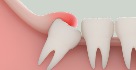什么是智齿智齿的病因和症状有哪些 如果出现智齿一定要尽早去医院就医