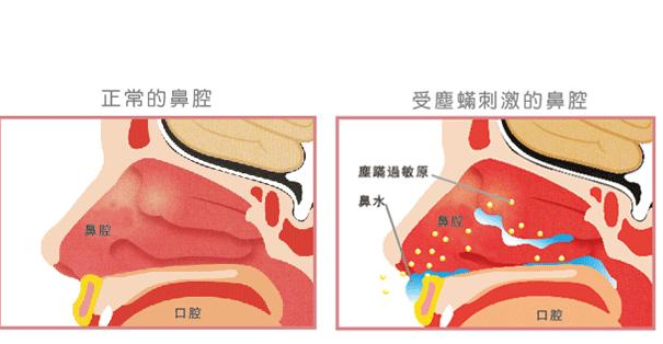 过敏性鼻炎的自我疗法，用这几种方法好的更快