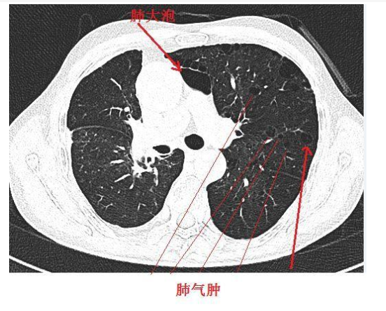 肺气肿吃什么药好，肺气肿有哪些改善方法？