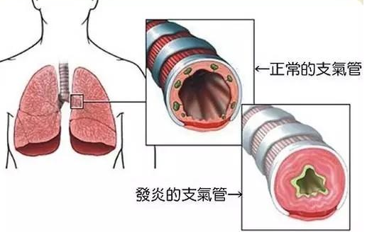 支气管炎吃什么好？支气管炎有哪些需要注意的地方？