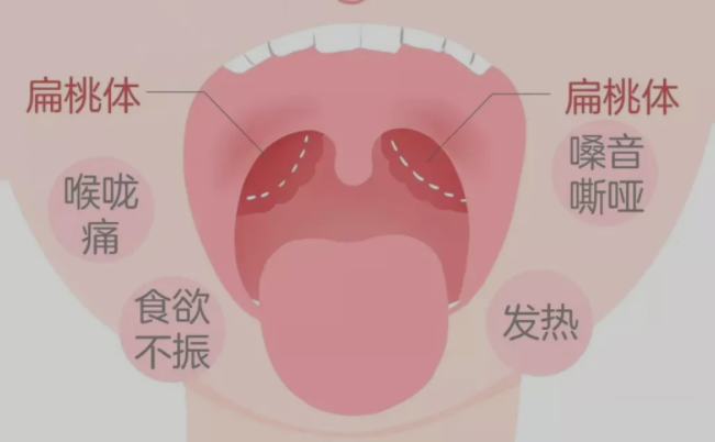 扁桃体发炎怎么快速缓解