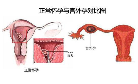 宫外孕的症状？宫外孕的早期表现有哪些？