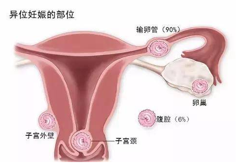 宫外孕的症状？宫外孕的早期表现有哪些？