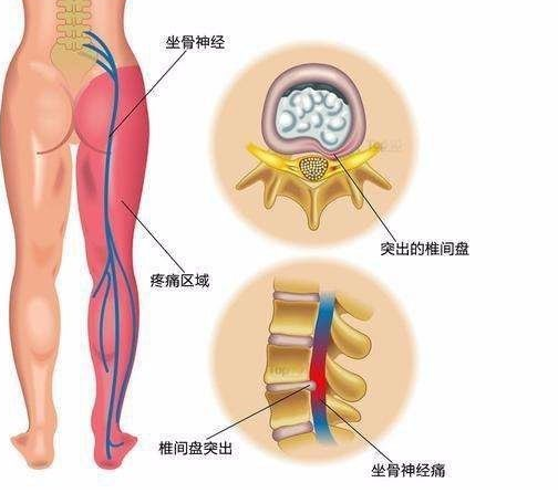 坐骨神经痛的症状是什么？坐骨神经痛怎么缓解？