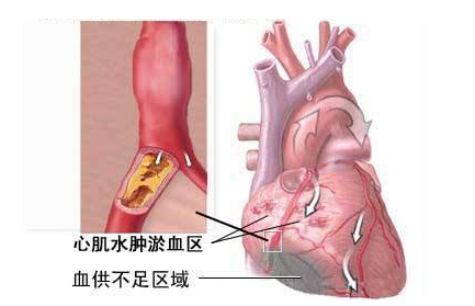 心肌缺血的症状是什么？心肌缺血是什么原因？