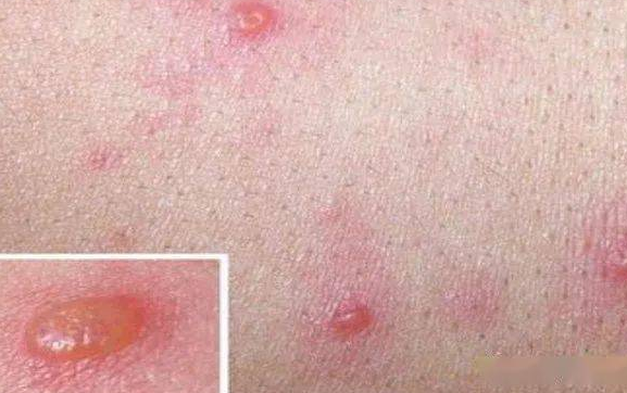 水痘的症状，水痘怎么预防不被传染？