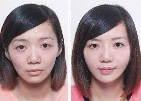 牙套脸是一种畸变吗?牙套脸怎么保养才能恢复?