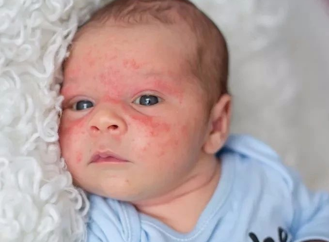 婴儿湿疹如何护理？婴儿湿疹怎么预防？