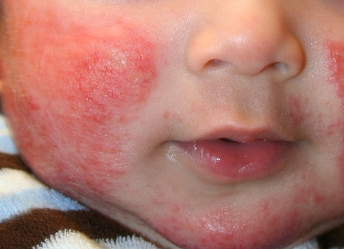 婴儿湿疹如何护理？婴儿湿疹怎么预防？