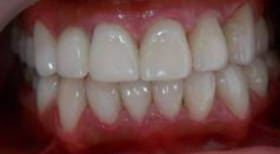 牙龈炎的症状？怎么判断是否得了牙龈炎？