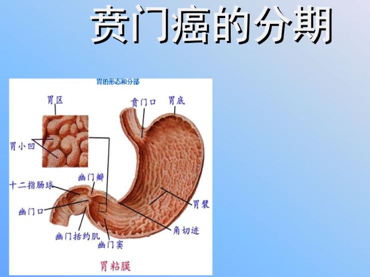 贲门癌是什么病？贲门癌的症状表现有哪些？