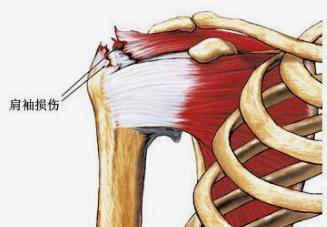 肩袖撕裂患者请远离侧平举杠铃等运动 肩袖发病率随着年龄增长而升高