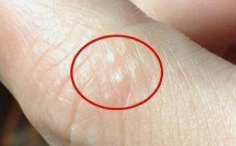 手指有小水泡：指尖出现什么意味着我们的身体需要排毒了呢?
