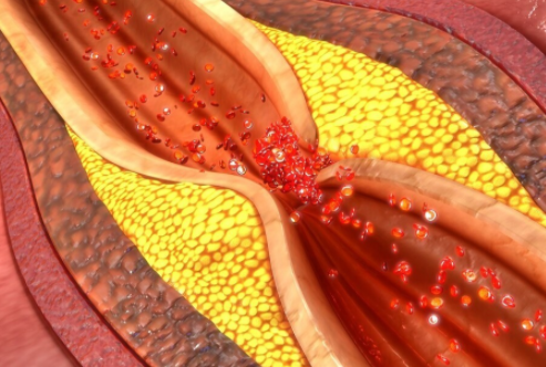 睡前喝水可以降低血液粘稠？引起血栓的原因是什么？如何才能预防血栓发生？