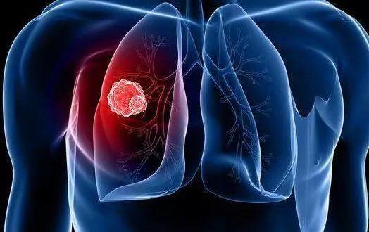 肺癌有什么症状?2021最新预防肺癌方法