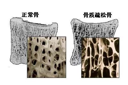  【健康小常识】骨质疏松怎么办?骨质疏松应该怎样预防?
