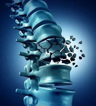  【健康小常识】骨质疏松怎么办?骨质疏松应该怎样预防?