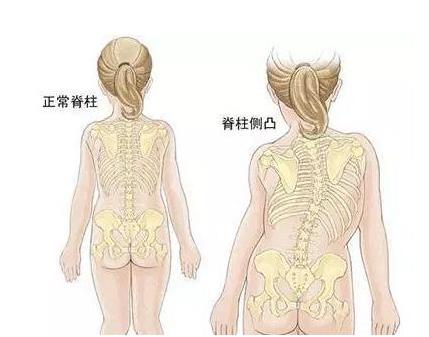  儿童和青少年脊柱侧凸的原因是什么?脊柱侧凸有哪些非手术治疗方法?