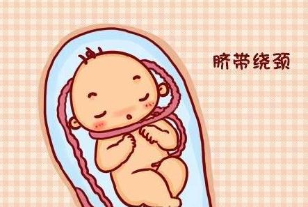 脐带绕颈怎么办?怎样才能防止胎儿脐带绕颈? 脐带绕颈怎么办?怎样才能防止胎儿脐带绕颈?