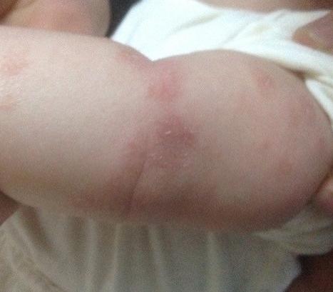 宝宝为什么会得干性湿疹?干性湿疹宝宝该怎么洗澡?