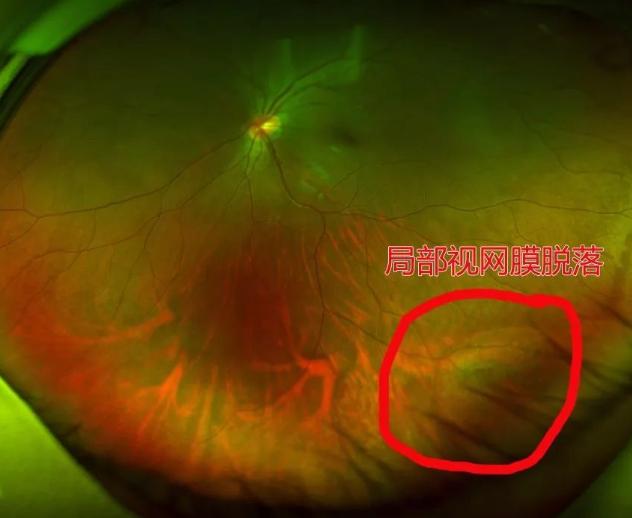 视网膜脱离是什么?怎样避免视网膜脱离?