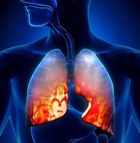 什么是间质性肺病?间质性肺病怎样分类?
