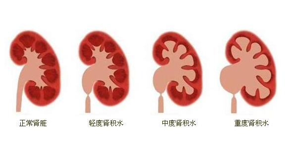 肾积水是什么?儿童肾积水是如何形成的?