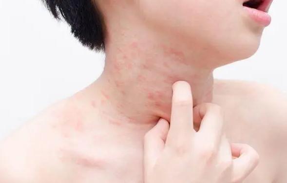 秋季最容易得什么皮肤疾病?最新关于秋季皮肤疾病的预防方法 秋季最容易得什么皮肤疾病?最新关于秋季皮肤疾病的预防方法