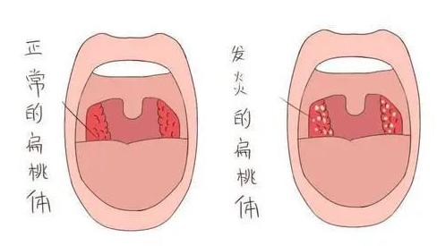 小孩扁桃体发炎引起发烧应该怎么办？春季如何预防小孩扁桃体发炎？