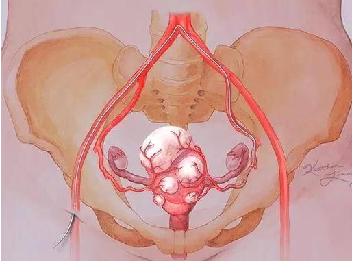 子宫肌瘤是怎么造成的？子宫肌瘤不能吃什么？