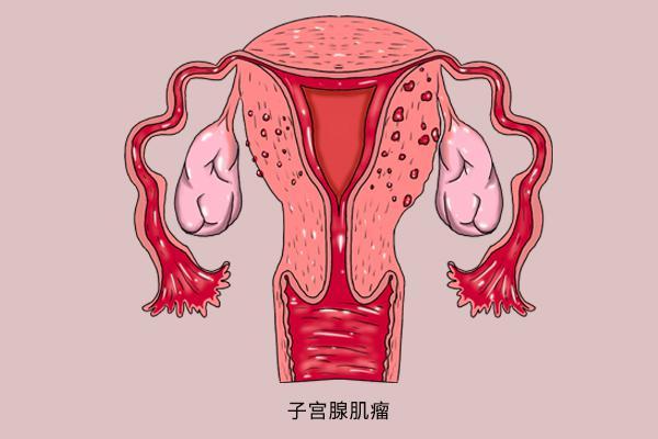 体检时查出子宫肌瘤是否要手术切除哪些情况下不能犹豫