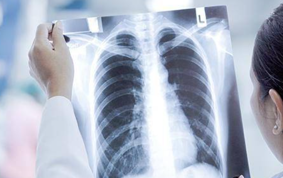 重症白肺死亡率40%以上 造成白肺的原因有哪些