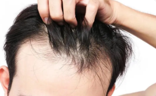 脱发严重是什么原因引起的?如何有效的防止脱发?