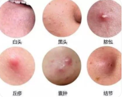 青春期女孩脸上长痘痘是什么原因?长痘痘是什么原因导致的? 青春期女孩脸上长痘痘是什么原因?长痘痘是什么原因导致的?