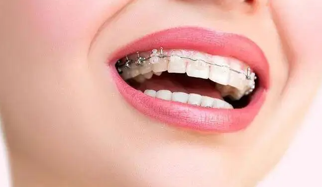 口腔正畸是不是要拔除健康的牙齿？口腔正畸为什么要拔除健康的牙齿？
