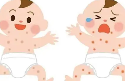 新生儿湿疹怎样治疗?治疗新生儿湿疹最有效的方法