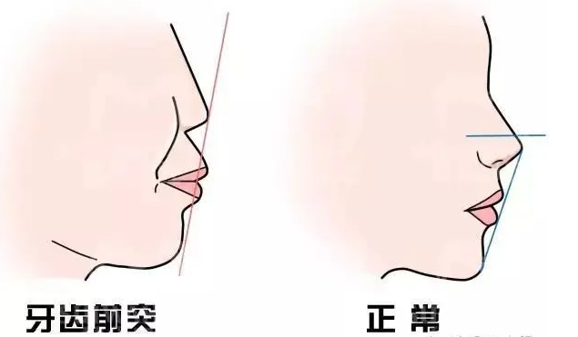 鼻基底填充手术千万别做！特别是有这三类特征的人做鼻基底填充要谨慎