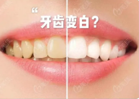 冷光美白牙齿有没有副作用?冷光牙齿美白后这样做才正确!