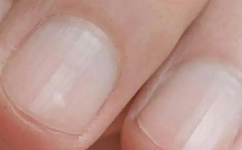 指甲中间有竖纹是怎么回事？指甲的不同颜色代表着什么疾病？