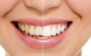 比较好的美白牙齿方法,有什么办法美白牙齿比较好?
