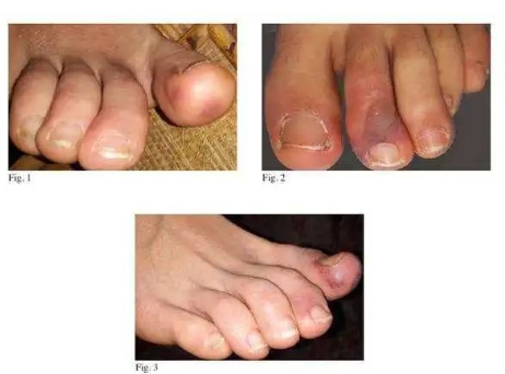 感染新冠病毒脚趾会发紫吗？感染新冠病毒后脚趾有啥症状？