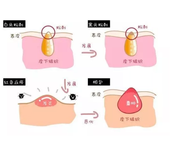 闭口粉刺老是长是为什么?哪些食物可以改善皮肤？