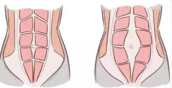 产后腹直肌分离怎么锻炼呢?产后腹直肌分离锻炼方法