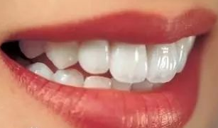 冷光美白牙齿副作用有哪些?你考虑过这个问题吗？