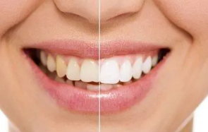 牙齿美白的方法,别再让牙黄成为你社恐的理由