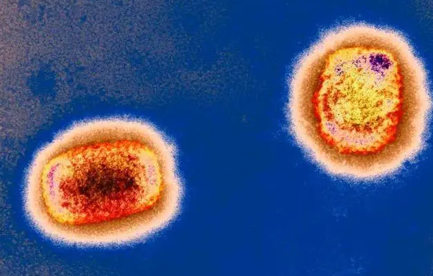 猴痘病毒与3年前英国毒株相近,猴痘病毒有哪些症状?