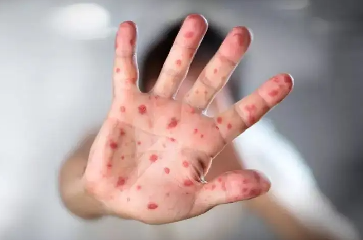 夏季这类病毒两种病进入高发期?2022科学预防助孩子远离手足口病