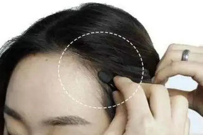 头发发际线慢慢后移是为什么？（哪些习惯会影响着你的头发健康？）