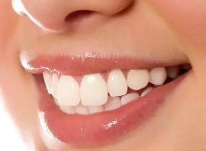 冷光美白牙齿效果,冷光美白牙齿适合哪些人群呢